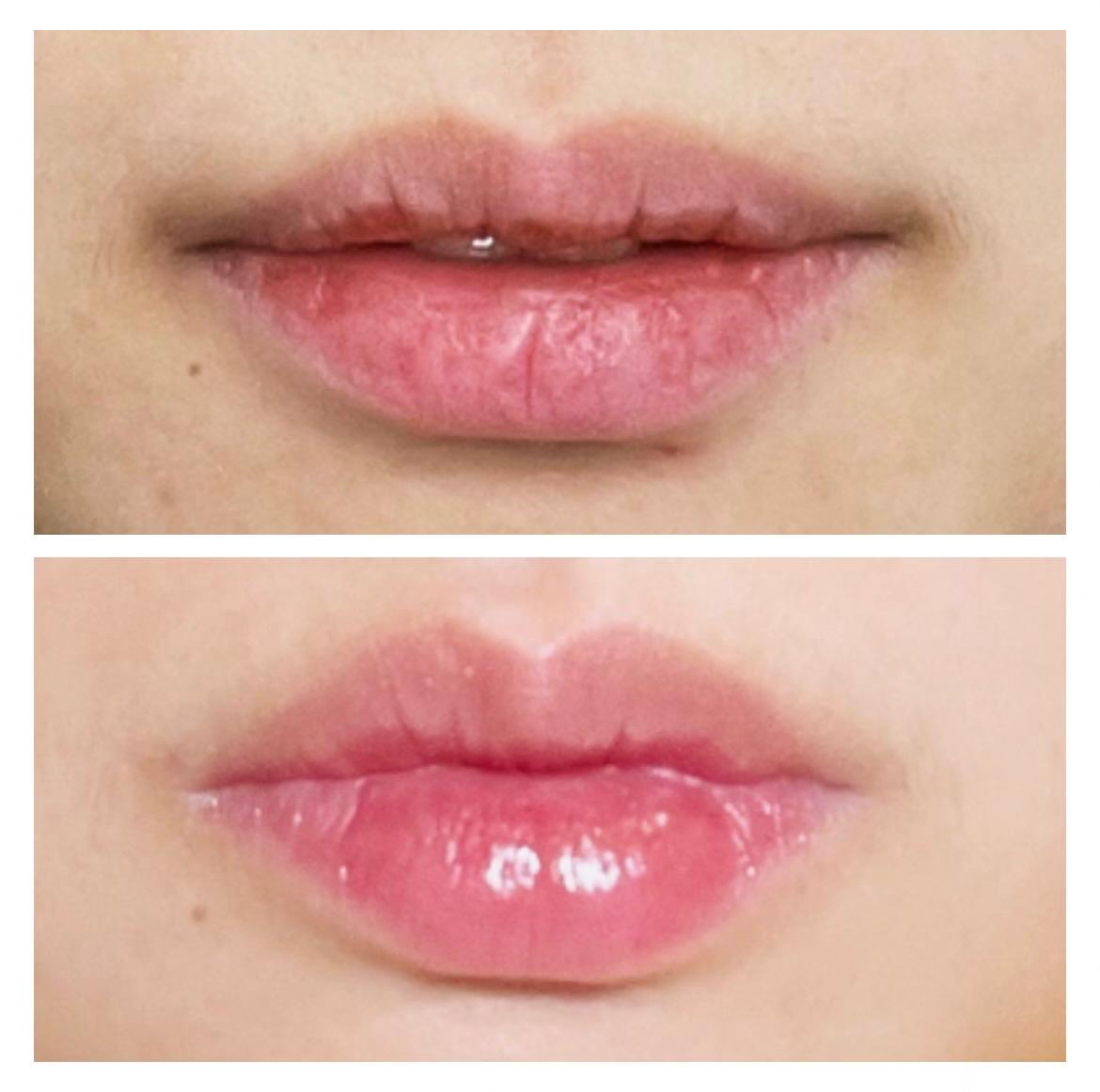 Restore Volume & Enhance Your Natural Beauty